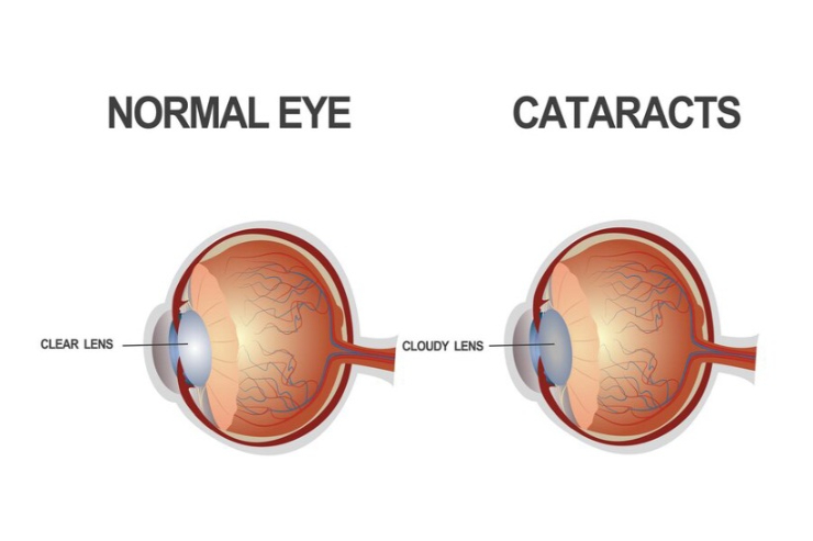 Cataracts,