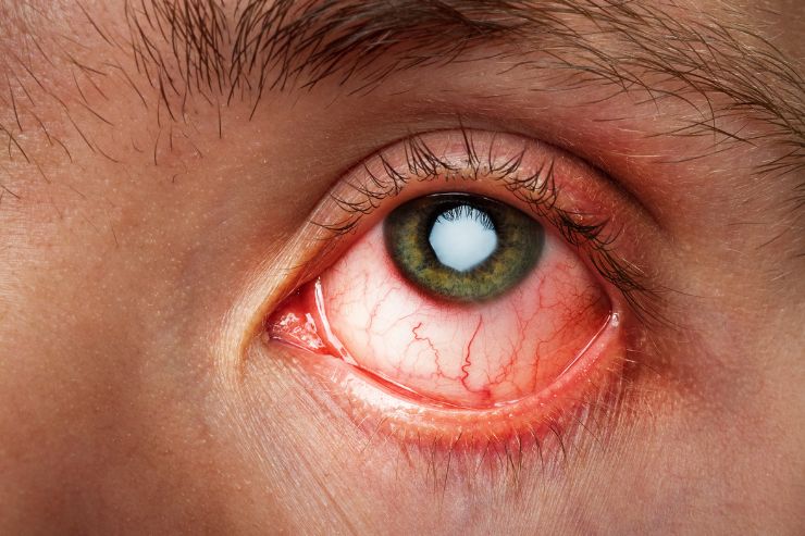 Conjunctival Disorders