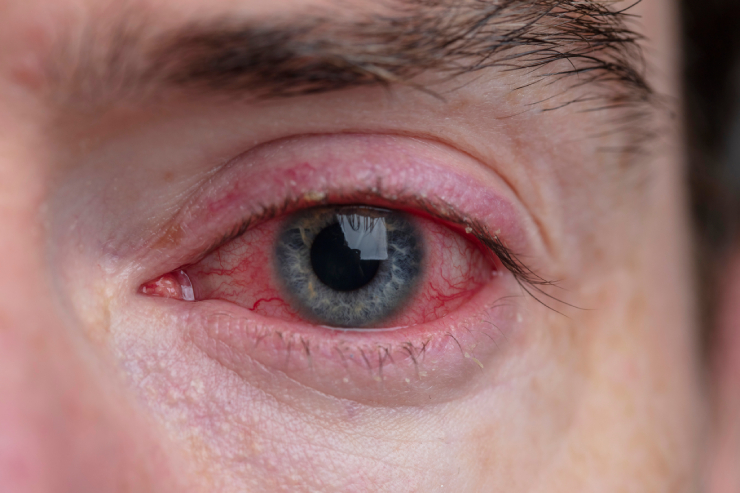 Conjunctivitis (Pink Eye),