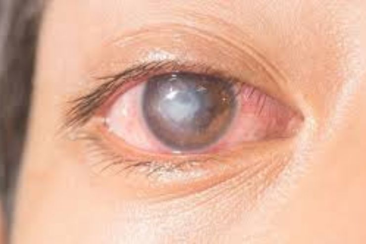 Corneal Ulcers