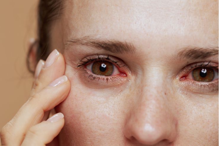 Dry Eye Syndrome