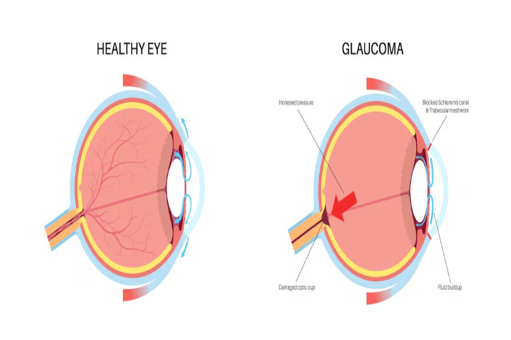 Glaucoma