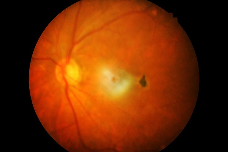 Retinal Detachment