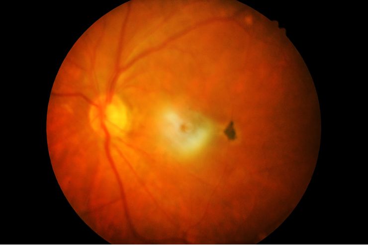 Retinitis Pigmentosa